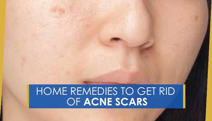 5 HOME REMEDIES TO GET RID OF ACNE SCARS